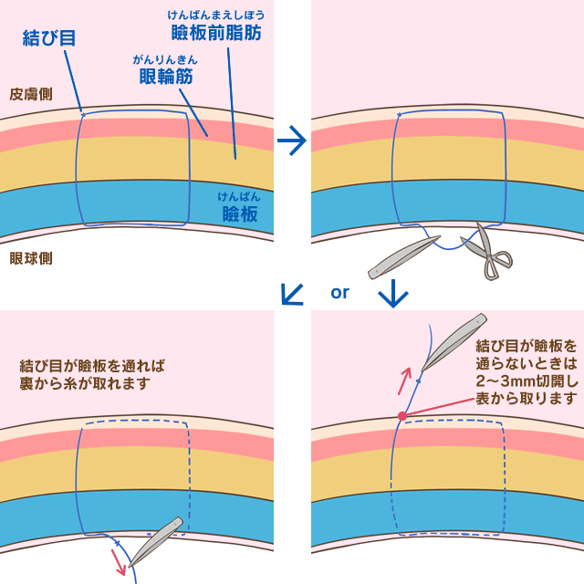 二重埋没法糸取りだし 二重まぶた 美容外科 美容整形のサラ美容外科愛知県 名古屋 脂肪吸引 豊胸 二重 レーザー脱毛 プチ整形 若返り